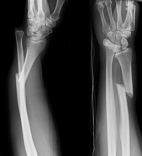 Fracture photos - Recovery. A Jones fracture will usually take about 6 weeks to heal. However, a person may still experience pain and swelling for 3–6 months. Often, a person will wear a boot or cast and ...